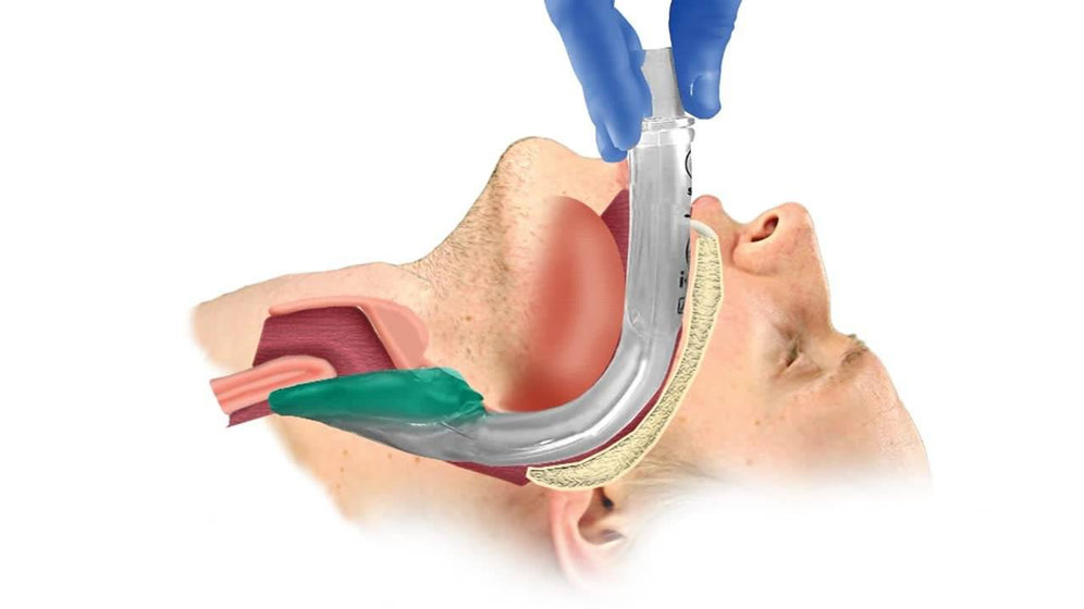 Airway Supralaryngeal Tube Kit